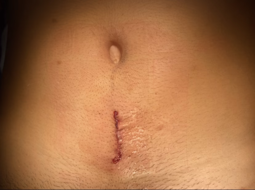 ALIF incisão minimamente invasiva coluna