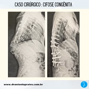 Caso cirúrgico: cifose congênita