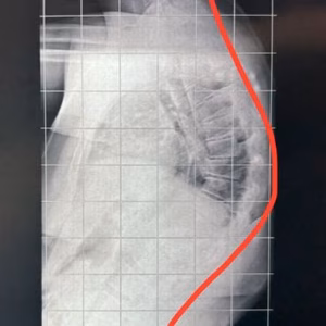 Cifose de Scheuermann: a famosa corcunda