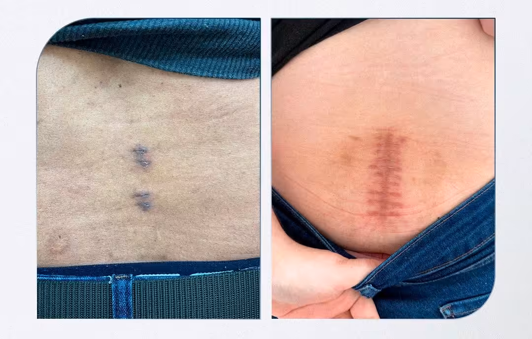 Endoscopia biportal da coluna