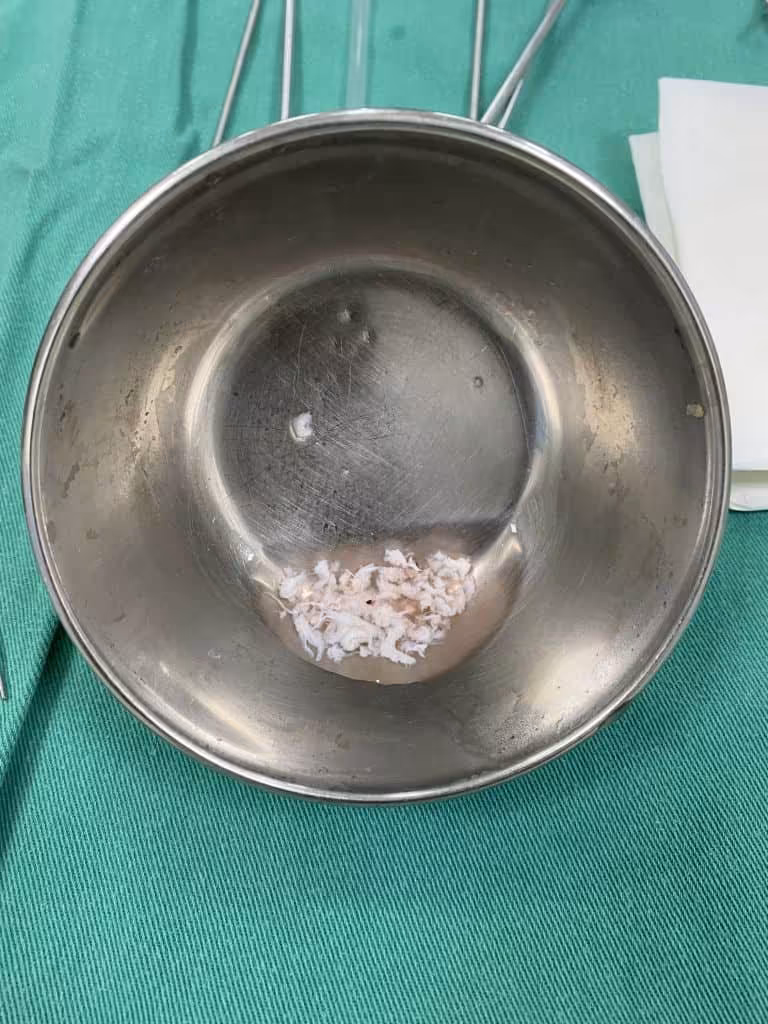 Hérnia de disco retirada por endoscopia