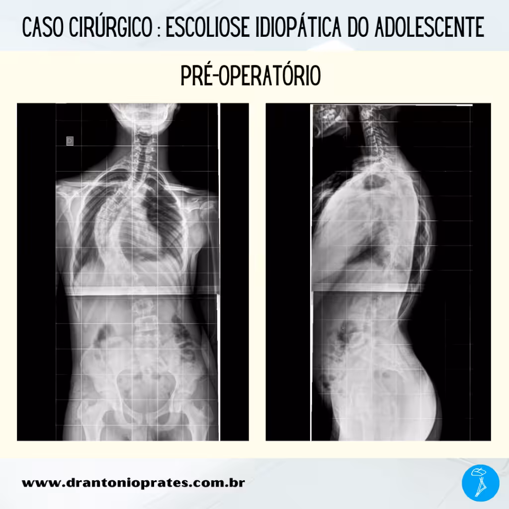 Escoliose idiopática
