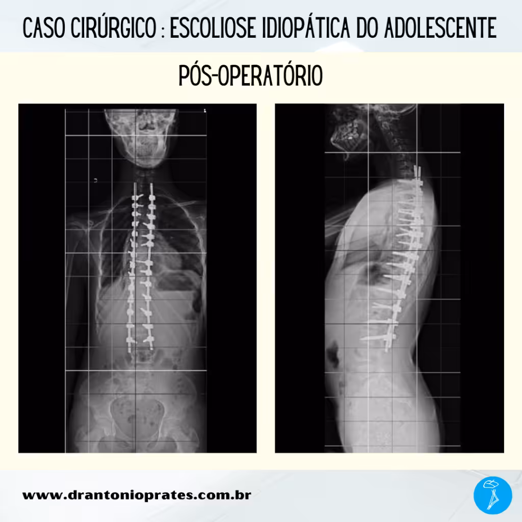 Escoliose idiopática