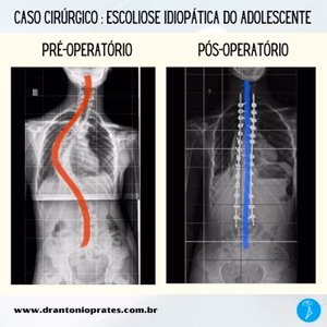 Escoliose idiopática adolescente