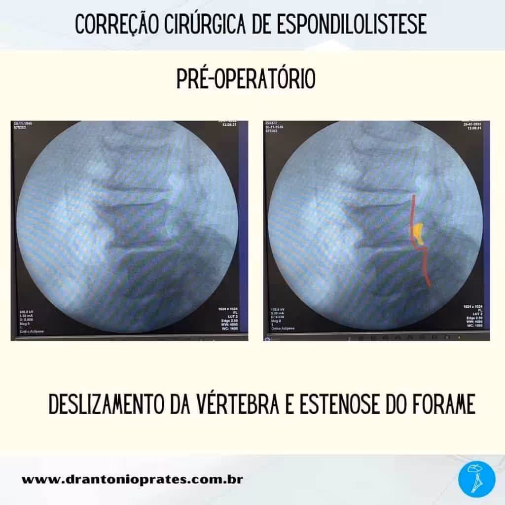 Espondilolistese - Imagem 1