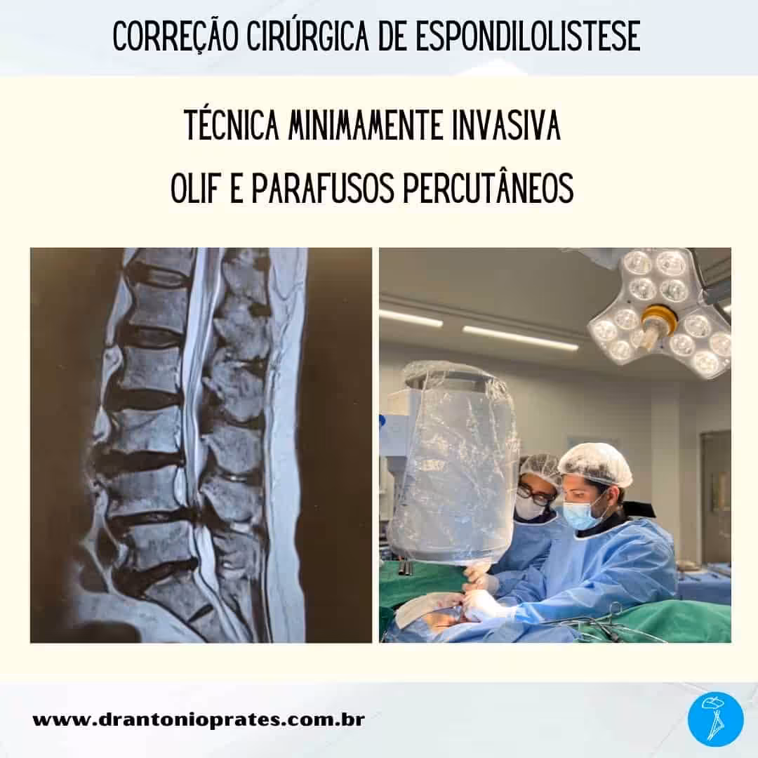 Espondilolistese - OLIF