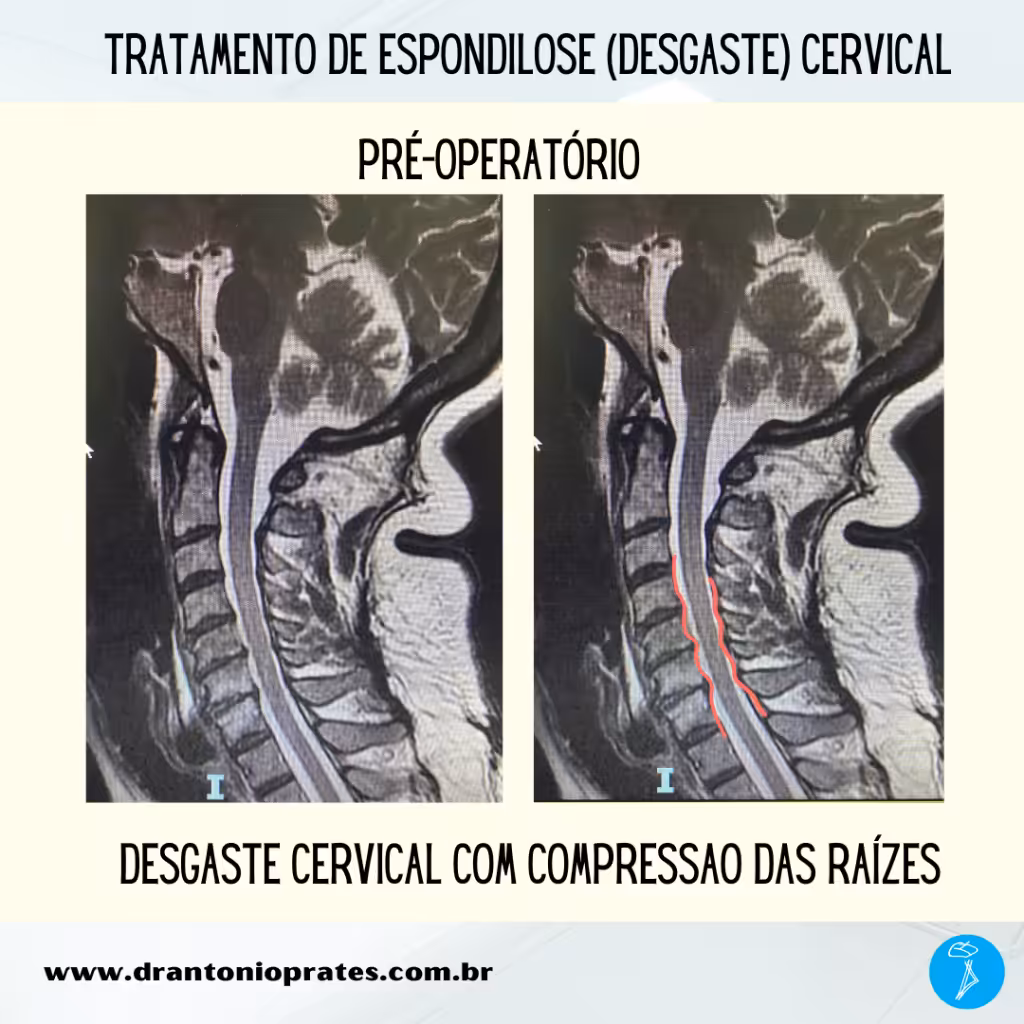 Espondilose cervical - Imagem 1