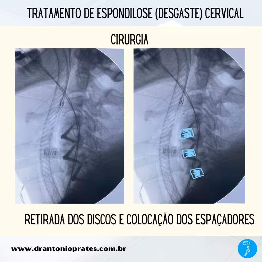 Espondilose cervical - Imagem 2