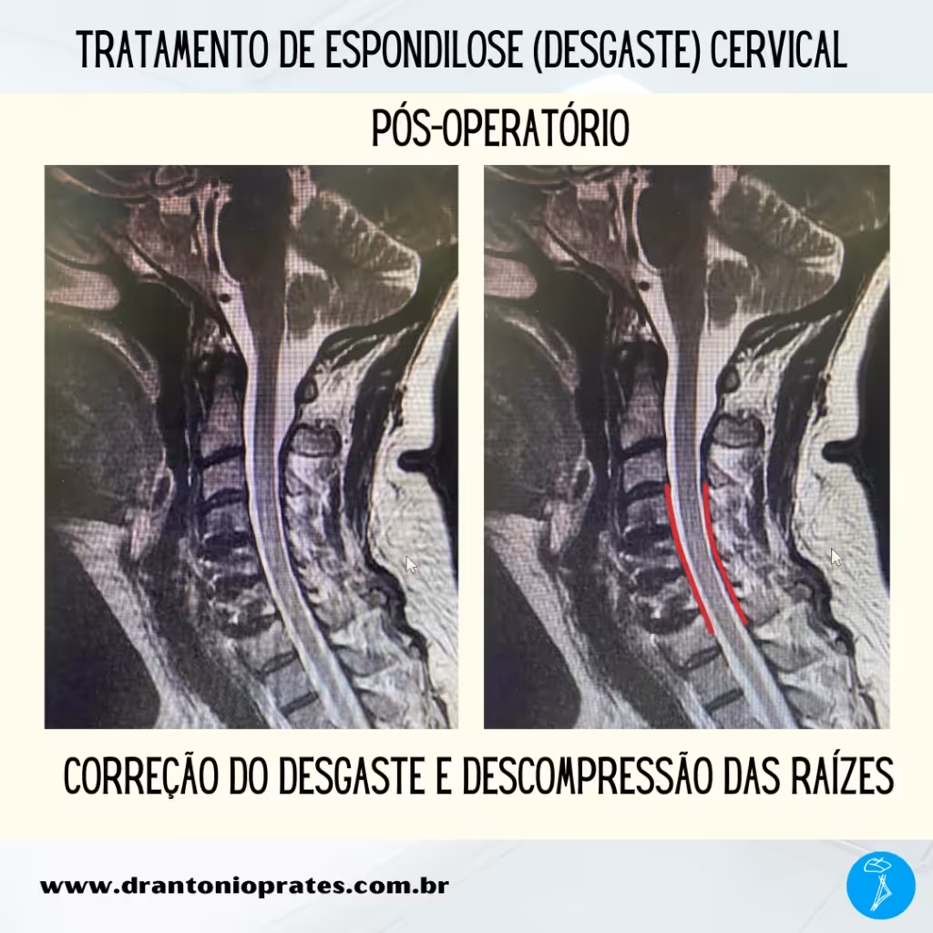 Espondilose cervical - Imagem 3