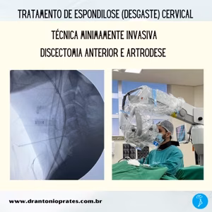 Espondilose cervical: caso clínico