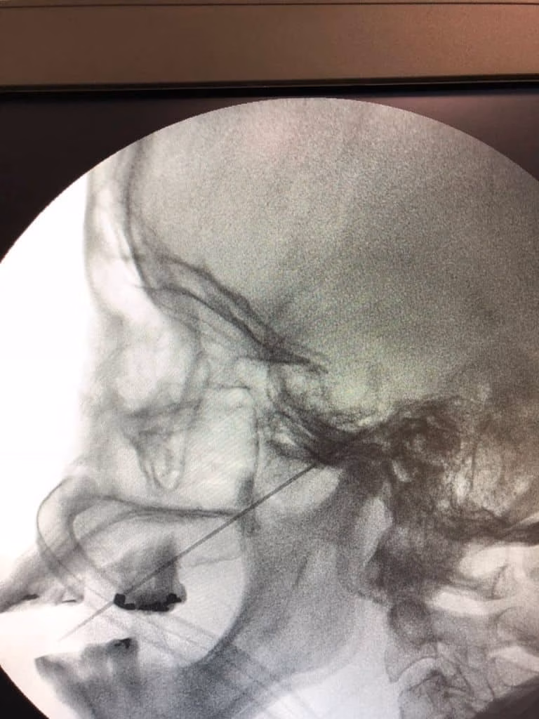 Neuralgia do trigêmeo - rizotomia