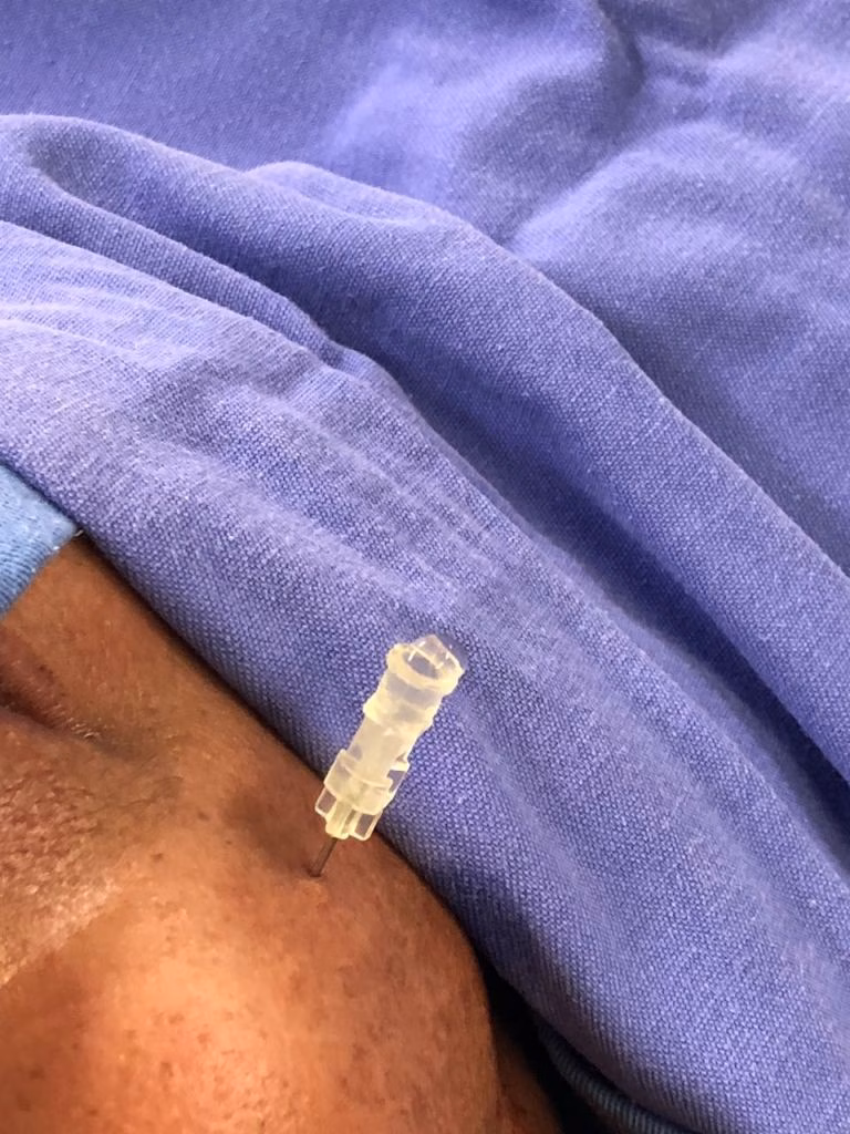 Neuralgia do trigêmeo - procedimento