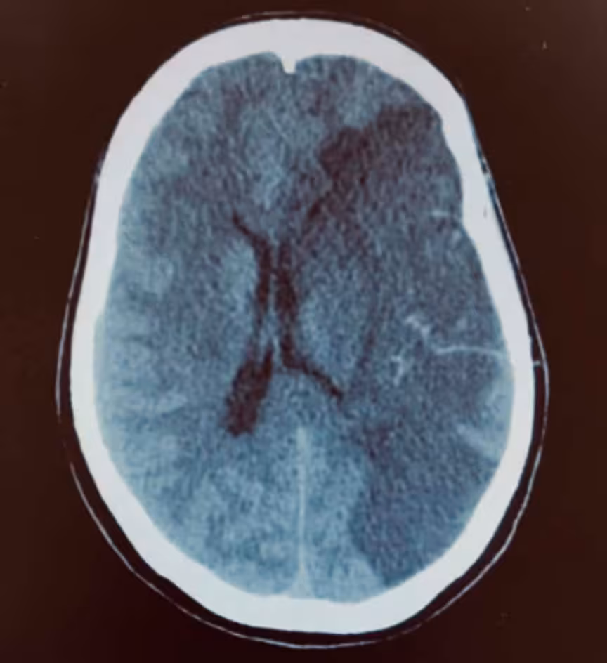 O Neurocirurgião e o AVC isquêmico