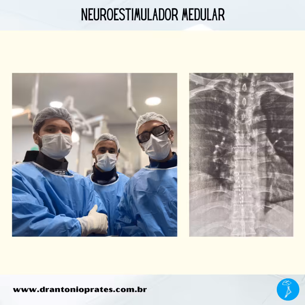 Neuroestimulador medular