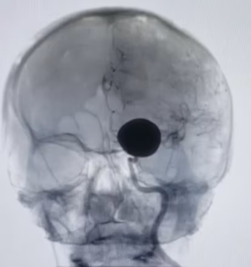 Aneurisma cerebral