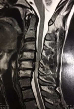 Cervicalgia e espondilose cervical