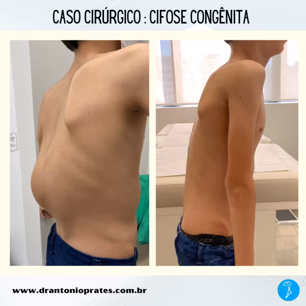 Cifose congênita - Dr Antônio Prates