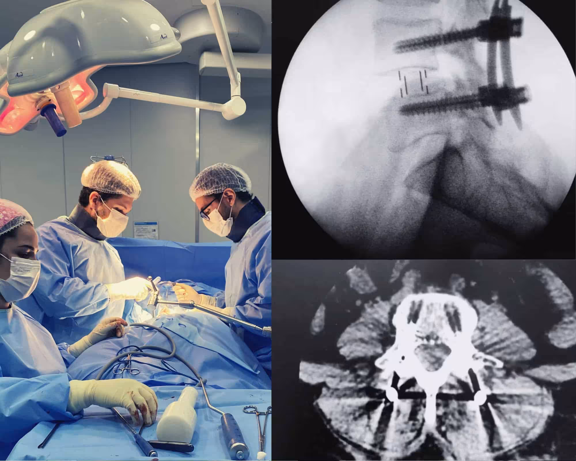Cirurgia minimamente invasiva da coluna