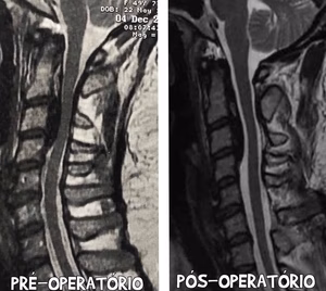 Dor cervical e Ossificação do ligamento longitudinal posterior