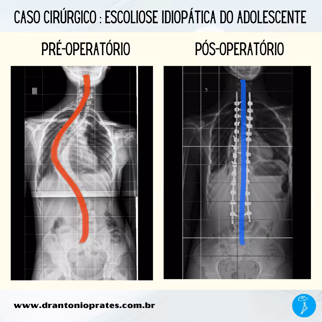 Escoliose idiopática do adolescente