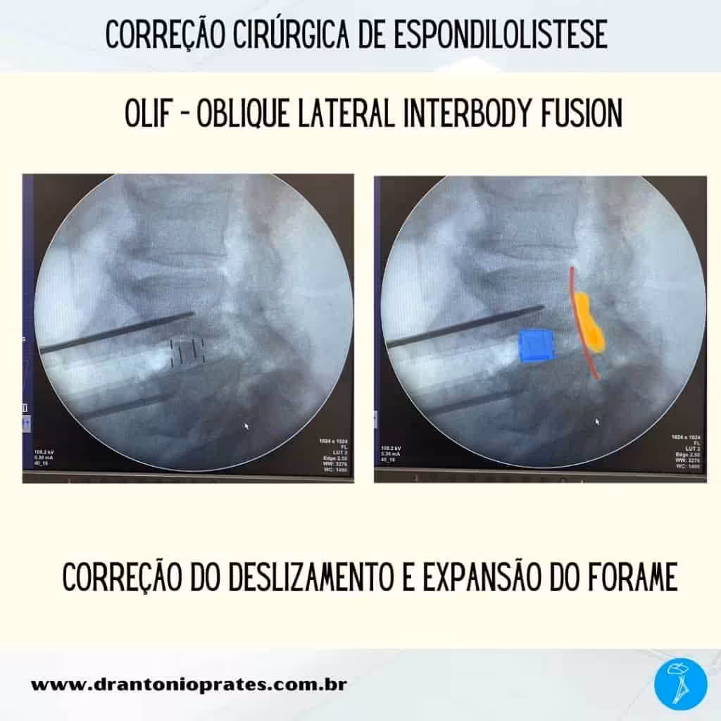 Espondilolistese - Imagem 2