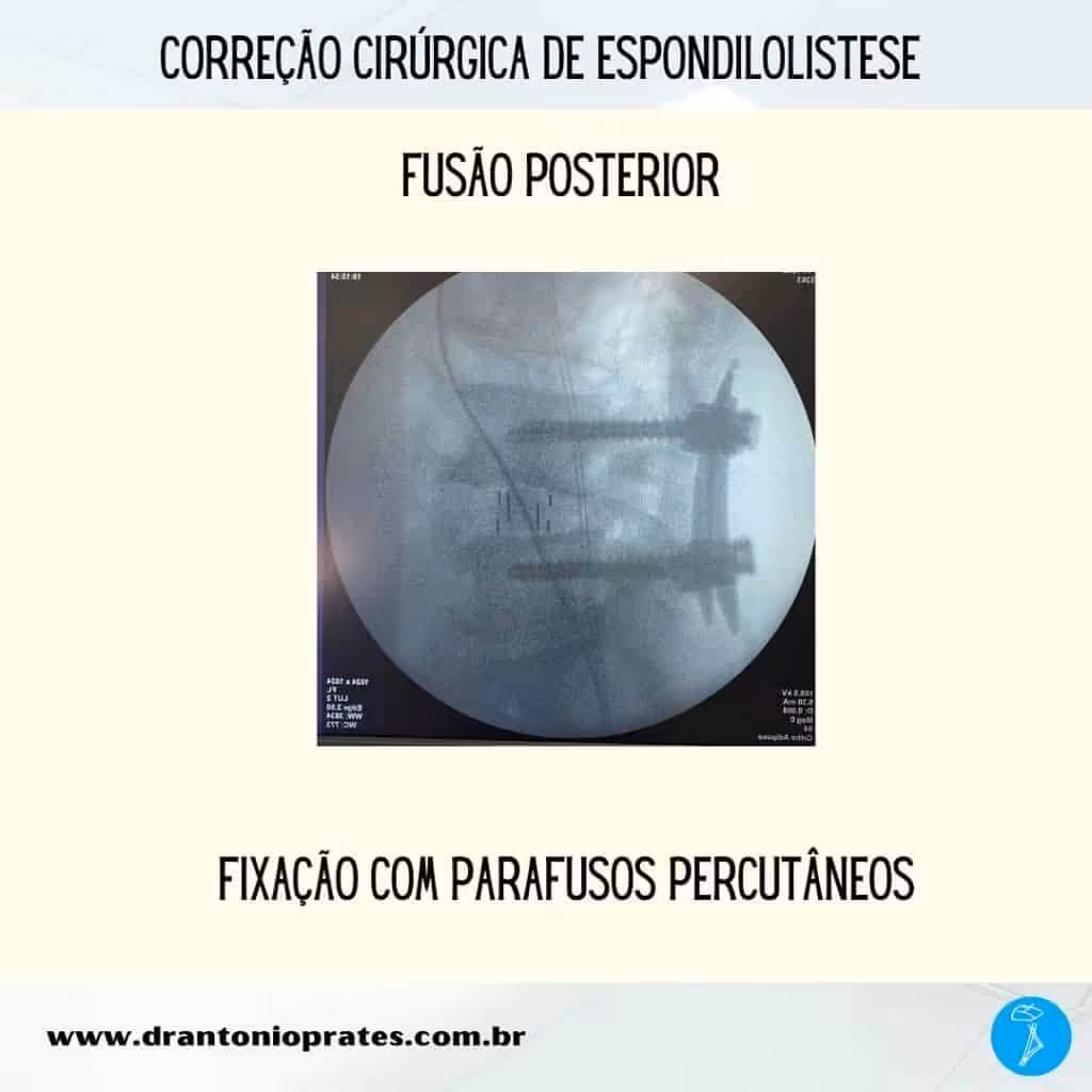 Espondilolistese - Imagem 3