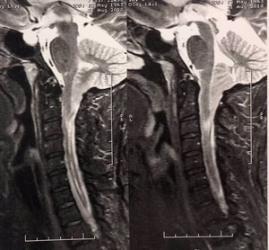 Malformação de Chiari tipo I e siringomielia