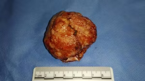 Meningioma